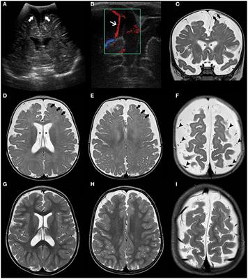 Diagnostic Approach to Macrocephaly in Children